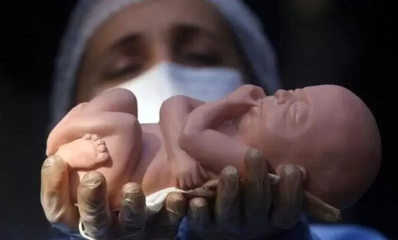 عمليات الإجهاض في إيران